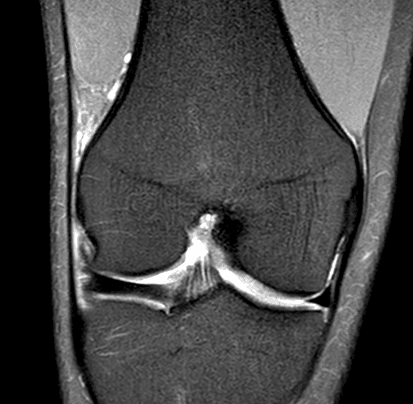 | PDFS coronal
