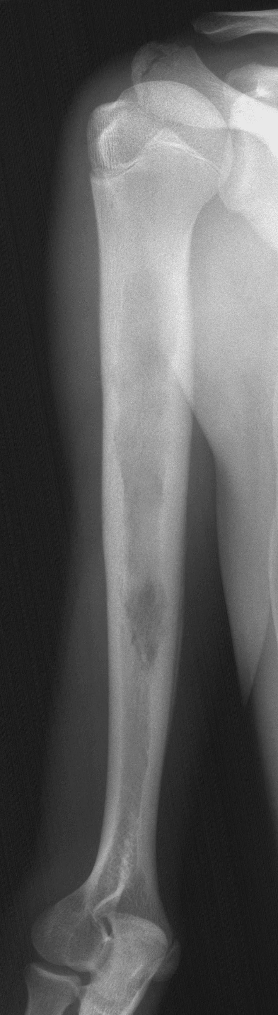 1. AP humerus