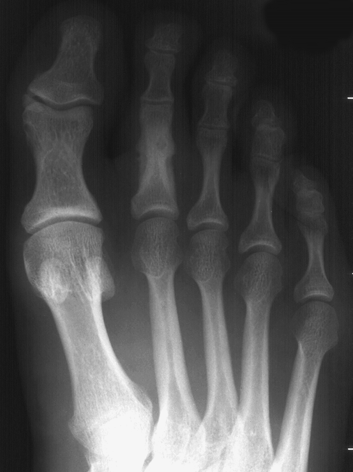 1. DP foot