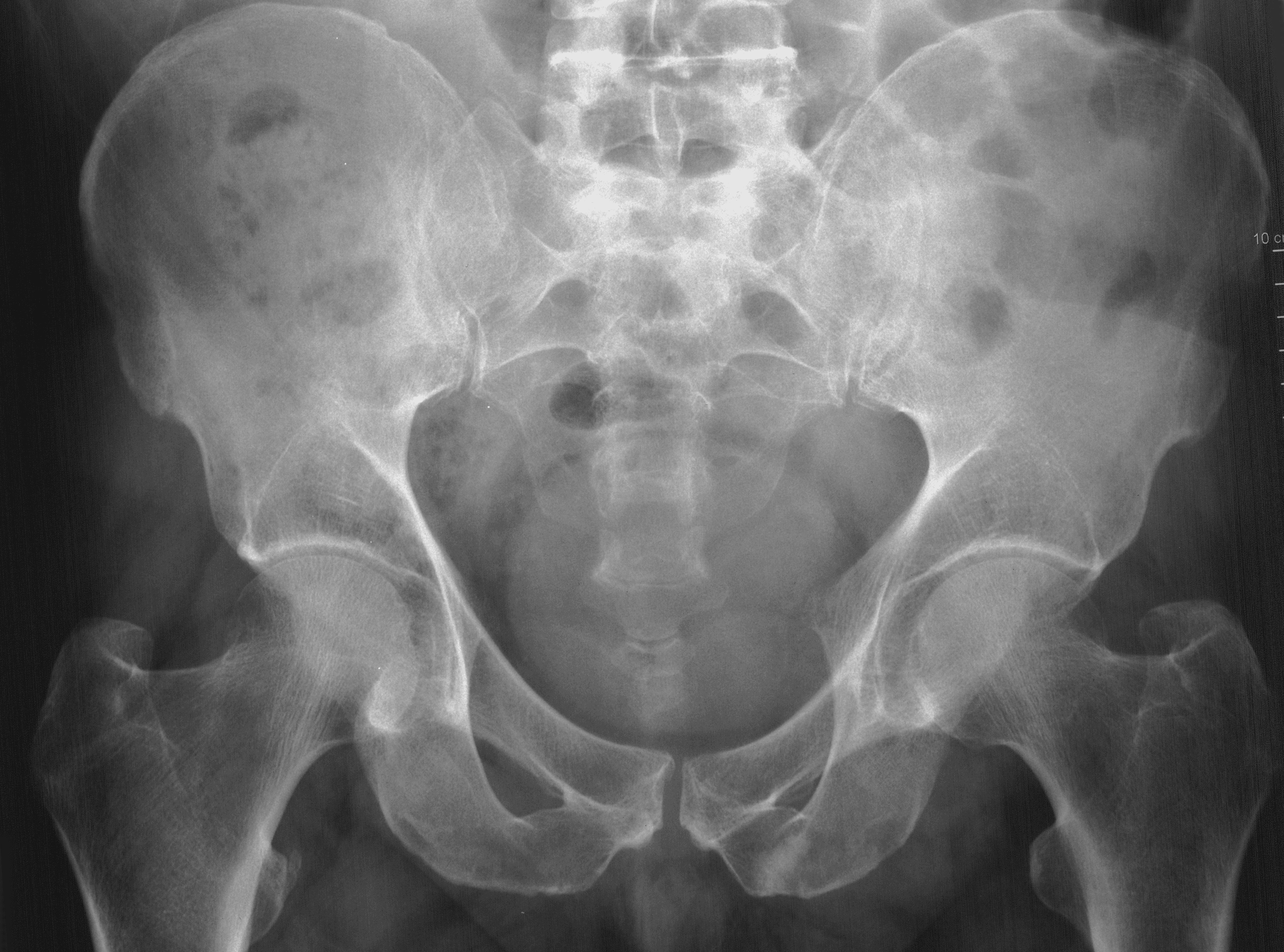 1. AP pelvis