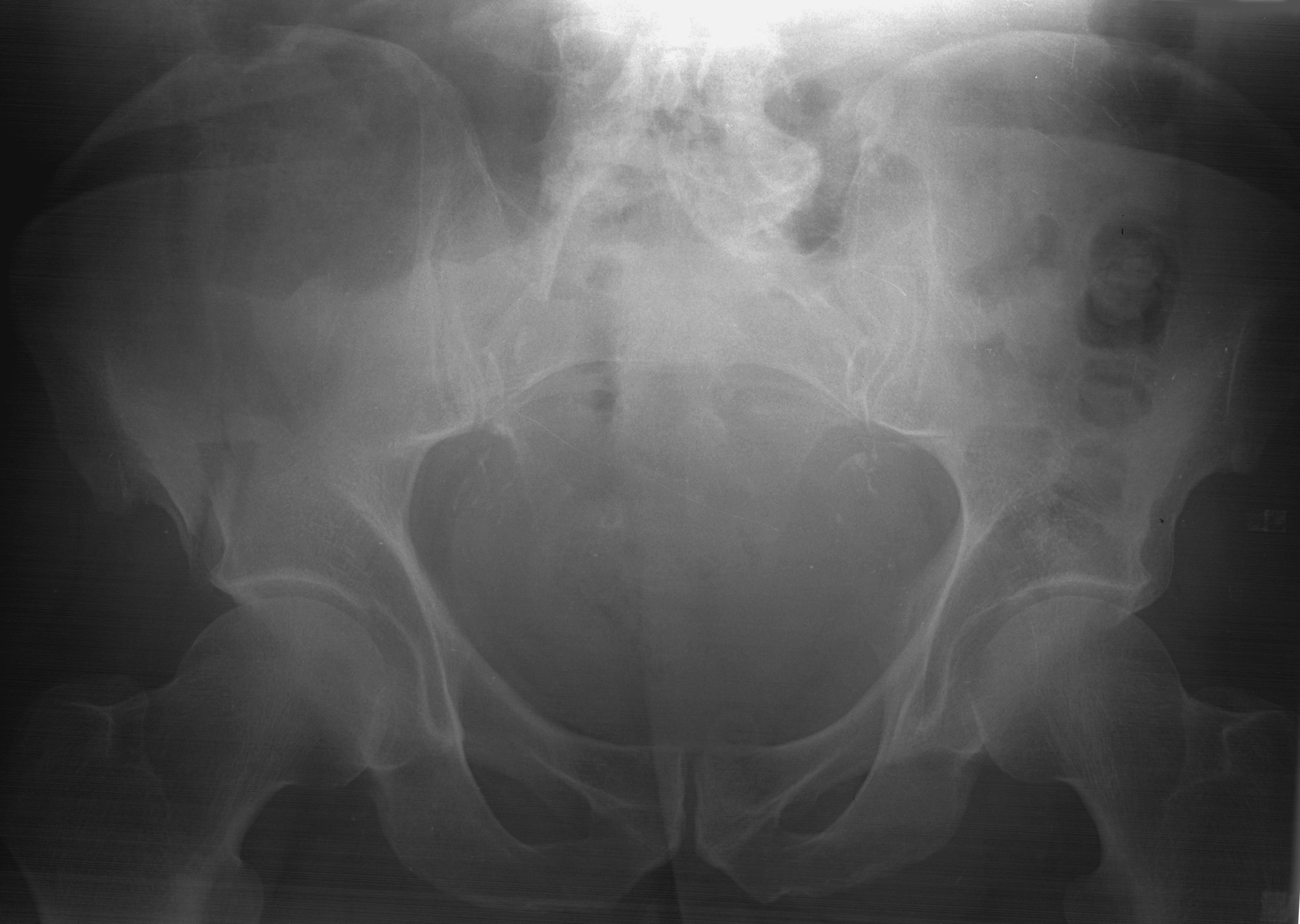 1. AP pelvis