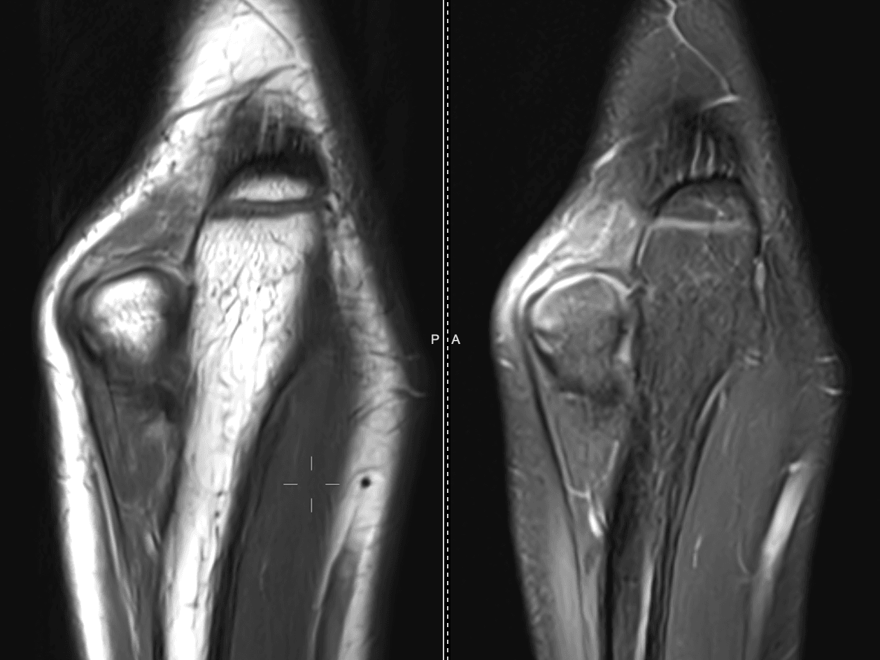 | PD and PDFS coronal